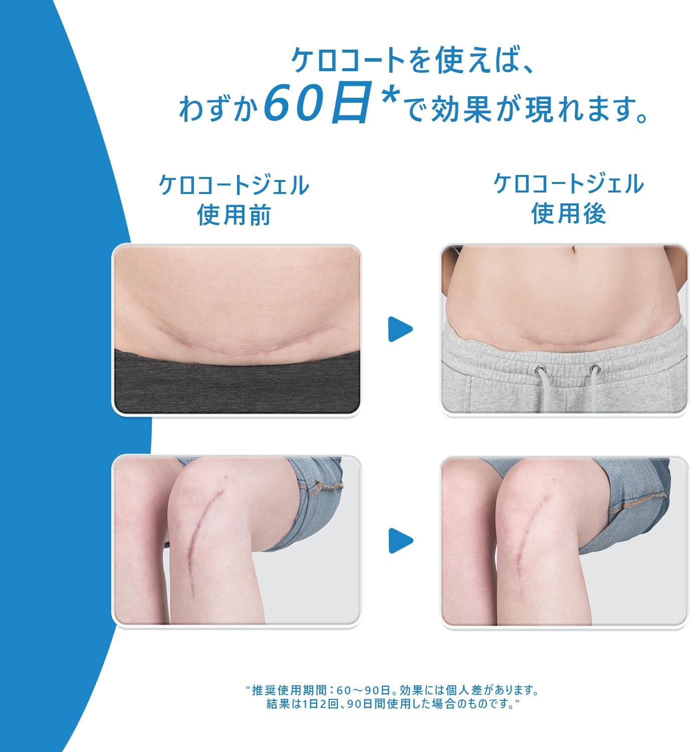 ケロコート6g｜傷跡をケアするジェル